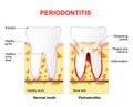 Periodontitis or pyorrhea Royalty Free Stock Photo