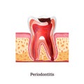 Periodontitis Realistic Illustration Royalty Free Stock Photo