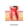 Periodontitis Realistic Illustration