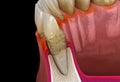 Periodontitis stage 3, gum recession, tartar. Medically accurate 3D illustration