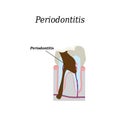 Periodontitis tooth. Vector illustration on Royalty Free Stock Photo