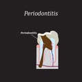 Periodontitis tooth. Vector illustration on a Royalty Free Stock Photo