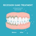 Periodontitis vector banner. Recession gums treatment. Stomatology dentistry concept