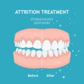 Periodontitis vector banner. Recession gums treatment. Stomatology dentistry conceptAttrition treatment vector. Stomatology dentis