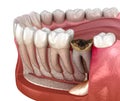 Periostitis tooth - Lump on Gum Above Tooth. Medically accurate dental 3D illustration Royalty Free Stock Photo