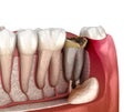 Periostitis tooth - Lump on Gum Above Tooth. Medically accurate dental 3D illustration Royalty Free Stock Photo