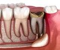 Periostitis tooth - Lump on Gum Above Tooth. Medically accurate dental 3D illustration Royalty Free Stock Photo