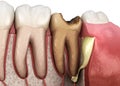 Periostitis tooth - Lump on Gum Above Tooth. Medically accurate dental 3D illustration Royalty Free Stock Photo