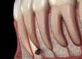 Periostitis tooth - Lump on Gum Above Tooth. Medically accurate dental 3D illustration Royalty Free Stock Photo