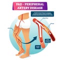 Peripheral artery disease PAD vector illustration. Labeled medical scheme. Royalty Free Stock Photo