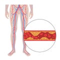 Peripheral artery disease