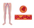 Peripheral artery disease