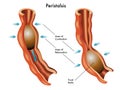 Peristalsis