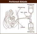 Peritoneal dialysis are both used to treat kidney - vector illus