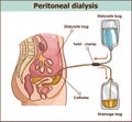 Peritoneal dialysis are both used to treat kidney - vector illus