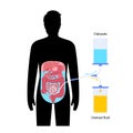 Peritoneal dialysis concept