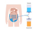 Peritoneal dialysis concept