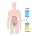 Peritoneal dialysis concept