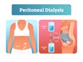 Peritoneal dialysis vector illustration. Labeled method to exchange fluids. Royalty Free Stock Photo