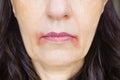 Perleche perioral dermatitis woman mouth