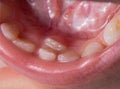 A permanent molar in a child grows second row. Incorrect growth of molars or polyodontia in dentistry, close-up