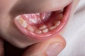 A permanent molar in a child grows second row. Incorrect growth of molars or polyodontia in dentistry, close-up