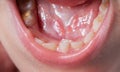 A permanent molar in a child grows second row. Incorrect growth of molars or polyodontia in dentistry, close-up