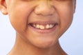 The permanent teeth in front of boys aged 8 to 10 years that are abnormal. Unusual permanent teeth are problems in eating and when Royalty Free Stock Photo