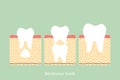 Permanent tooth located below primary tooth, anatomy structure including the bone and gum