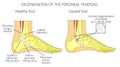 Peroneal Tendon Injuries_Degeneration of the peroneus longus and Royalty Free Stock Photo