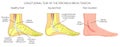 Peroneal Tendon Injuries_Longitudinal tear of the peroneus brevis tendon