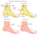 Peroneal Tendon Injuries_Peroneal tendon dislocation Royalty Free Stock Photo