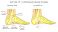 Peroneal Tendon Injuries_Rupture of the peroneus longus tendon Royalty Free Stock Photo