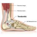 Peroneal tendonitis ,ankle joint 3d medical illustration