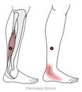 Myofascial trigger points in the Peroneus brevis muscle can cause pain in the outer ankle Royalty Free Stock Photo