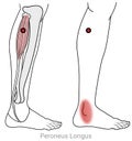 Peroneus longus: Myofascial trigger points referred pain in the foot and ankle.