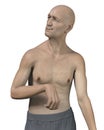 A person with Huntington's chorea, 3D illustration