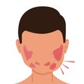 A person with inflamed salivary glands