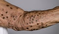 A person\'s arm with brown spots and wrinkles