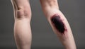 A person\'s leg with a black bruise on it