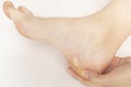 Person Shows Foot with Calluses, Skin Corns on Heel and Phalange of Toe. Water Blister