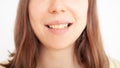 person smiles, shows teeth, yellow plaque, crooked teeth, malocclusion. woman