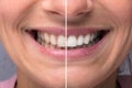 Person Teeth Before And After Whitening Royalty Free Stock Photo