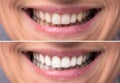 Person Teeth Before And After Whitening Royalty Free Stock Photo