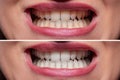 Person Teeth Before And After Whitening