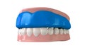 Gum Guard Fitted On Closed False Teeth