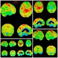 Pet ct alzheimer dementia pattern collage