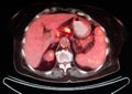 Pet/ct liver intestine nuclear medicine