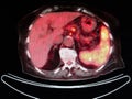 Pet/ct fr2 nuclear medicine