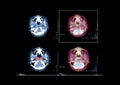 PET CT image of the brain showing CA nasopharynx. Royalty Free Stock Photo